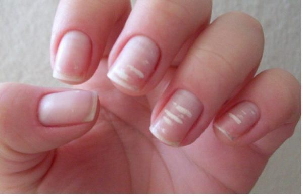  Las manchas blancas en la uñas que no necesariamente significan falta de calcio